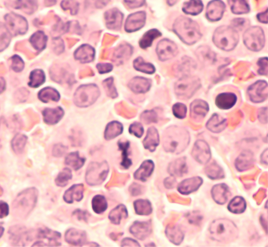 ما هو سرطان الدم الليمفاوي الحاد لدى الأطفال (pALL)?
