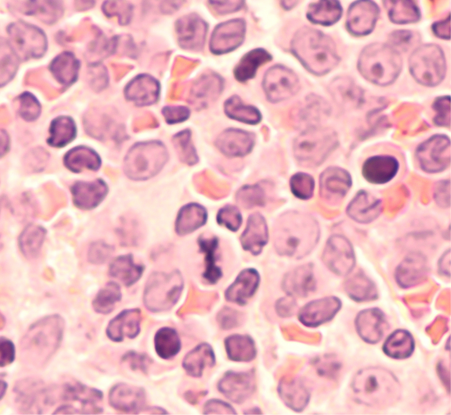 What is Pediatric Acute Lymphoblastic Leukemia (pALL)?